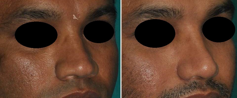 Cosmetic surgery of nose Ernakulam